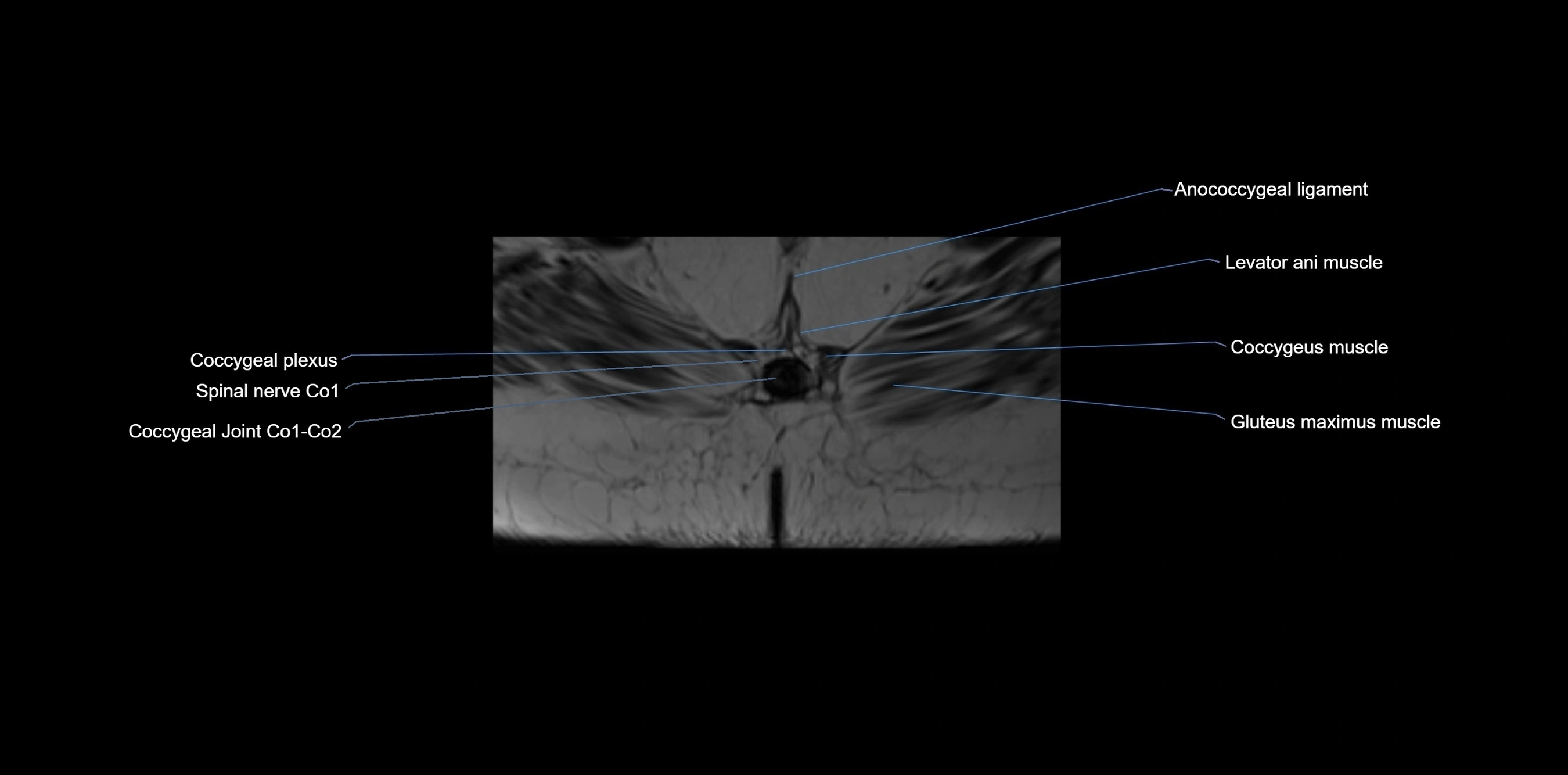 MRI sacrum, coccyx and sacroiliac joint axial cross sectional anatomy 3T  radiology  image-img-00001-00074.webp